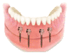 Implantat